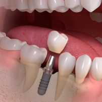 Derrylin Dental and Implant Centre County Fermanagh